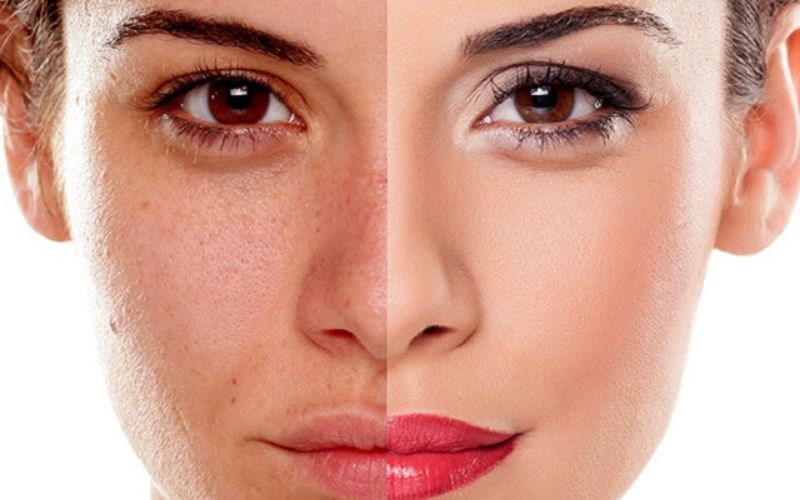 Công nghệ trẻ hóa Ultherapy mang đến hiệu quả chỉ sau một liệu trình trị liệu
